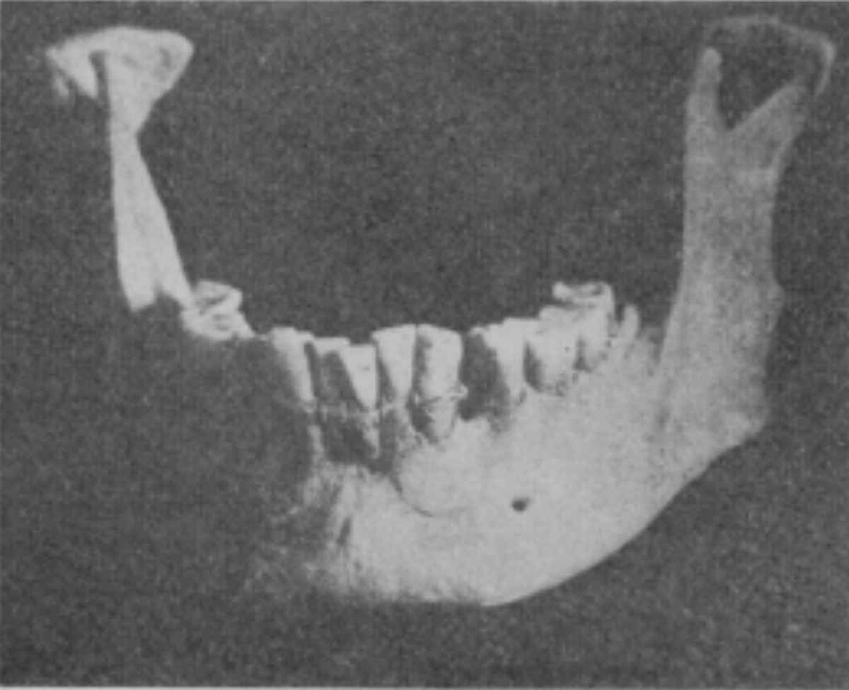 The first prosthodontic device to support loose teeth